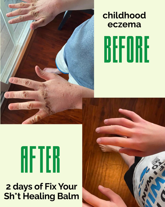 Eczema Treatment Today: Doctor-Recommended vs. Natural Healing